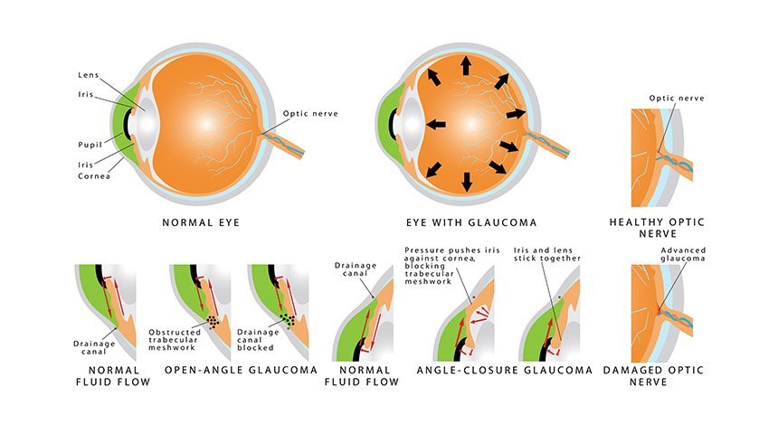 Diagnosing And Treating Glaucoma Ophthalmic Associates Southern Tier