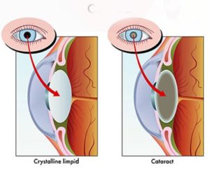 Cataract Surgery in Binghamton, NY | Sambursky Eye & Esthetics